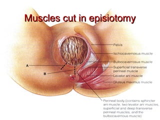 Muscles cut in episiotomyMuscles cut in episiotomy
 