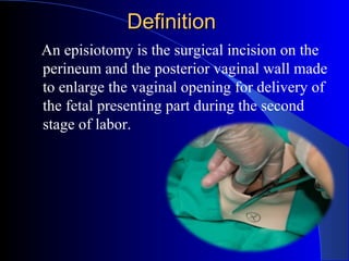 DefinitionDefinition
An episiotomy is the surgical incision on the
perineum and the posterior vaginal wall made
to enlarge the vaginal opening for delivery of
the fetal presenting part during the second
stage of labor.
 