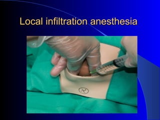 Local infiltration anesthesiaLocal infiltration anesthesia
 