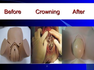 Before Crowning AfterBefore Crowning After
7
 