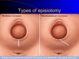 Types of episiotomyTypes of episiotomy
 
