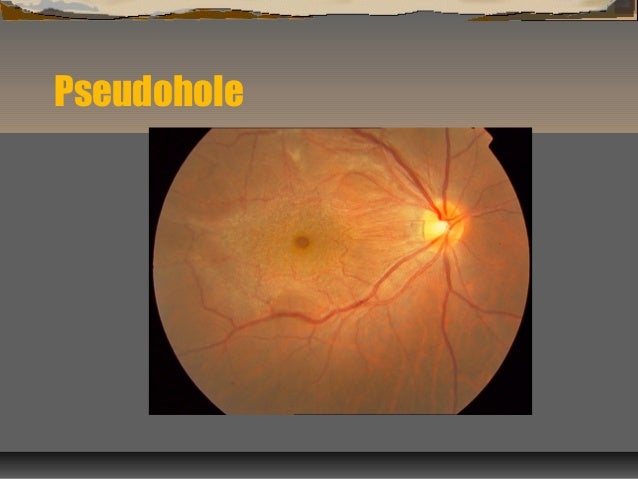 NW2010 Epiretinal Membrane NW2010 Epiretinal Membrane