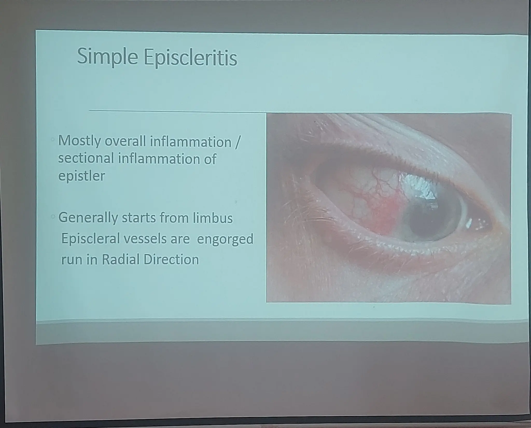 Episcelaritis Episcleritis, scleritis, ophthalmology.pdf