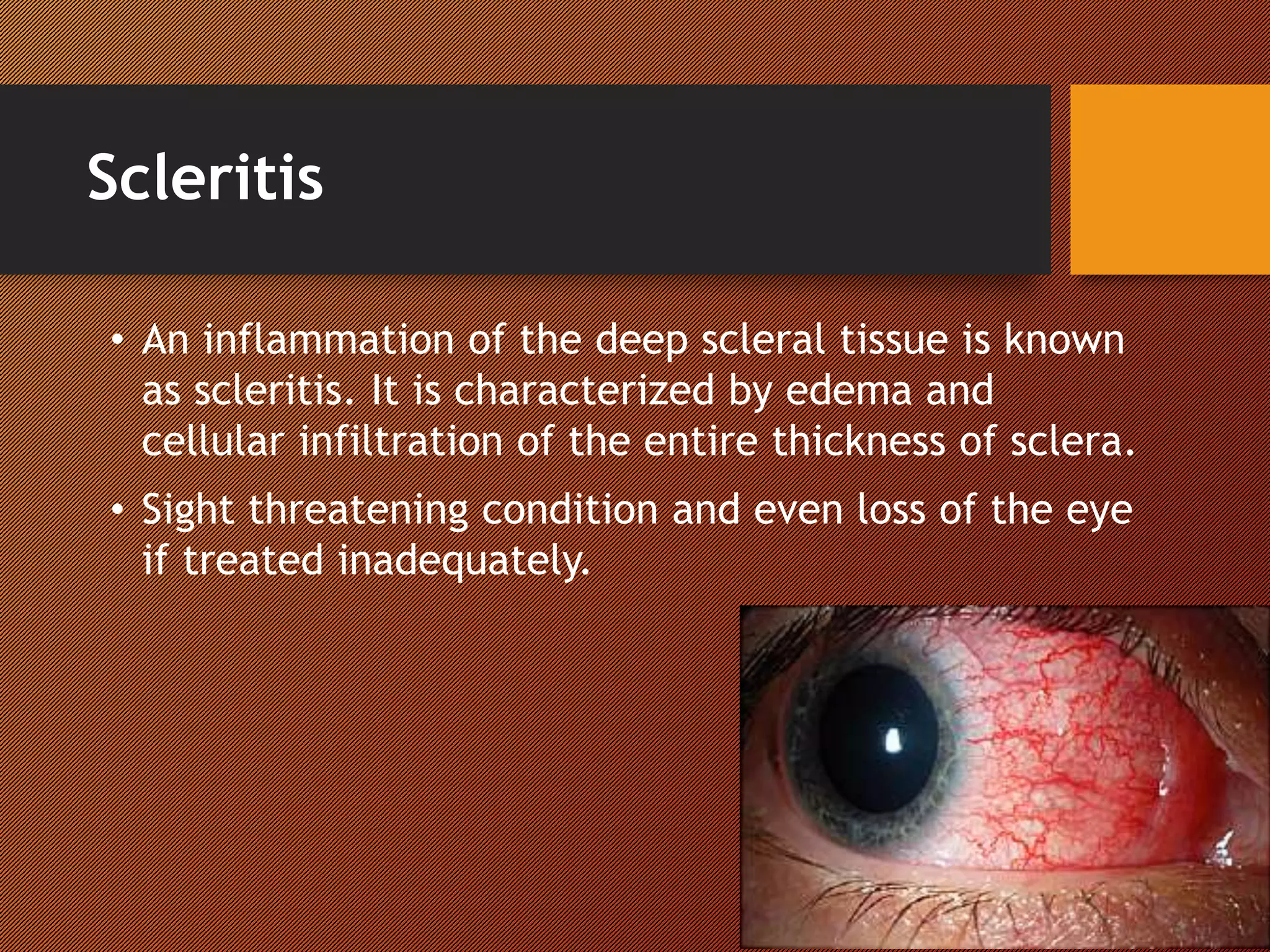 Scleritis
• An inflammation of the deep scleral tissue is known
as scleritis. It is characterized by edema and
cellular infiltration of the entire thickness of sclera.
• Sight threatening condition and even loss of the eye
if treated inadequately.
 