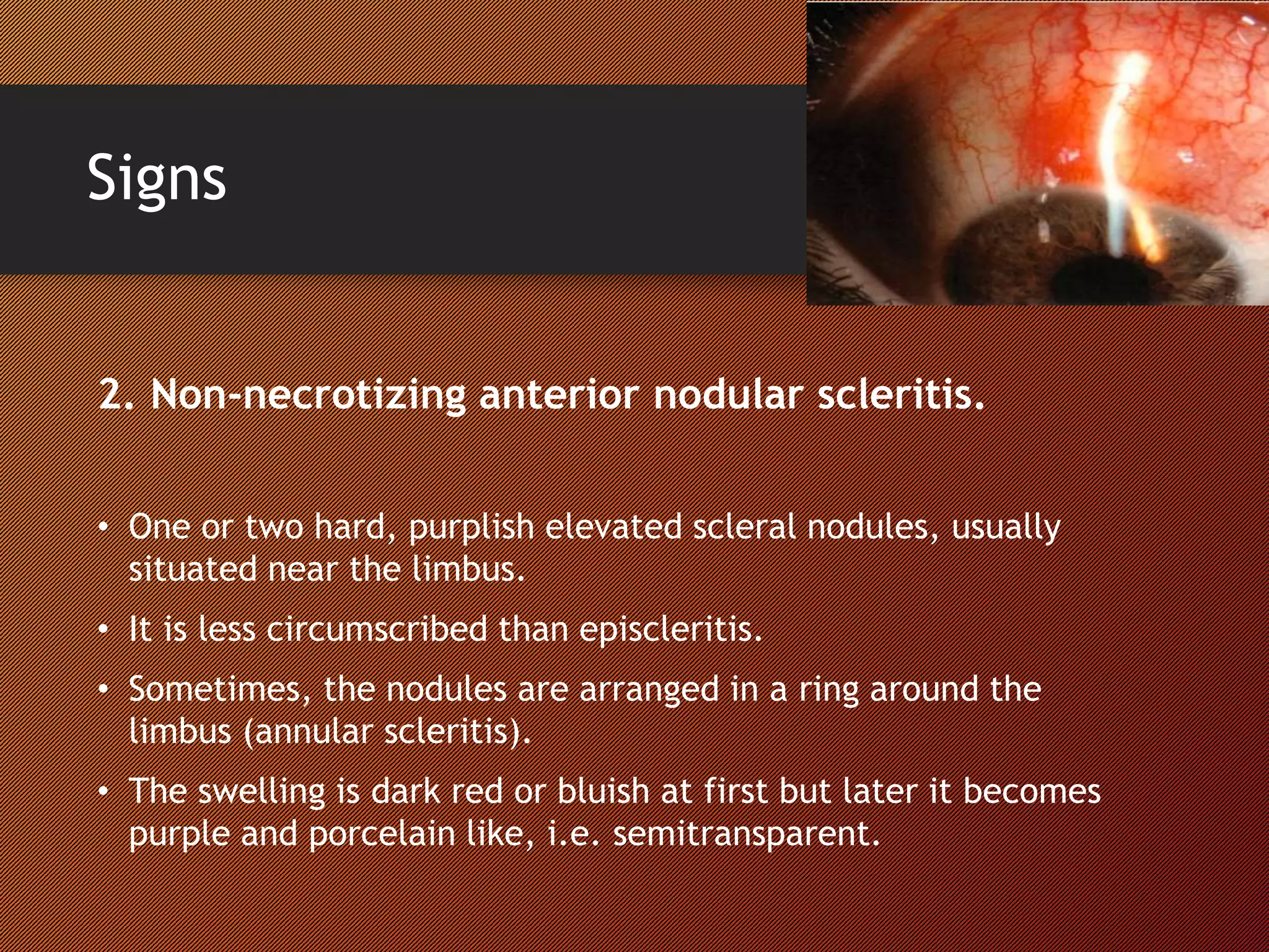 Signs
2. Non-necrotizing anterior nodular scleritis.
• One or two hard, purplish elevated scleral nodules, usually
situated near the limbus.
• It is less circumscribed than episcleritis.
• Sometimes, the nodules are arranged in a ring around the
limbus (annular scleritis).
• The swelling is dark red or bluish at first but later it becomes
purple and porcelain like, i.e. semitransparent.
 