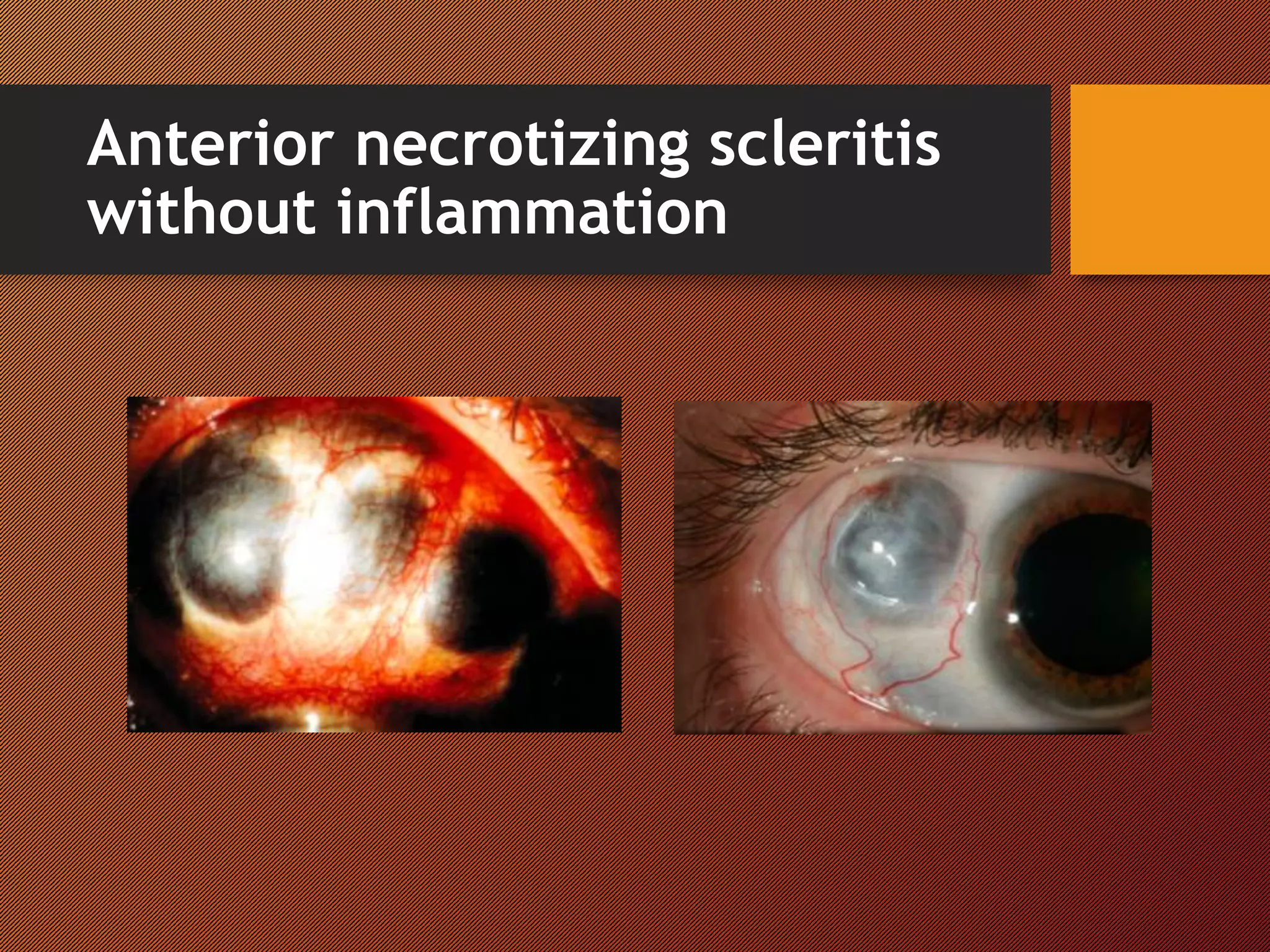 Anterior necrotizing scleritis
without inflammation
 