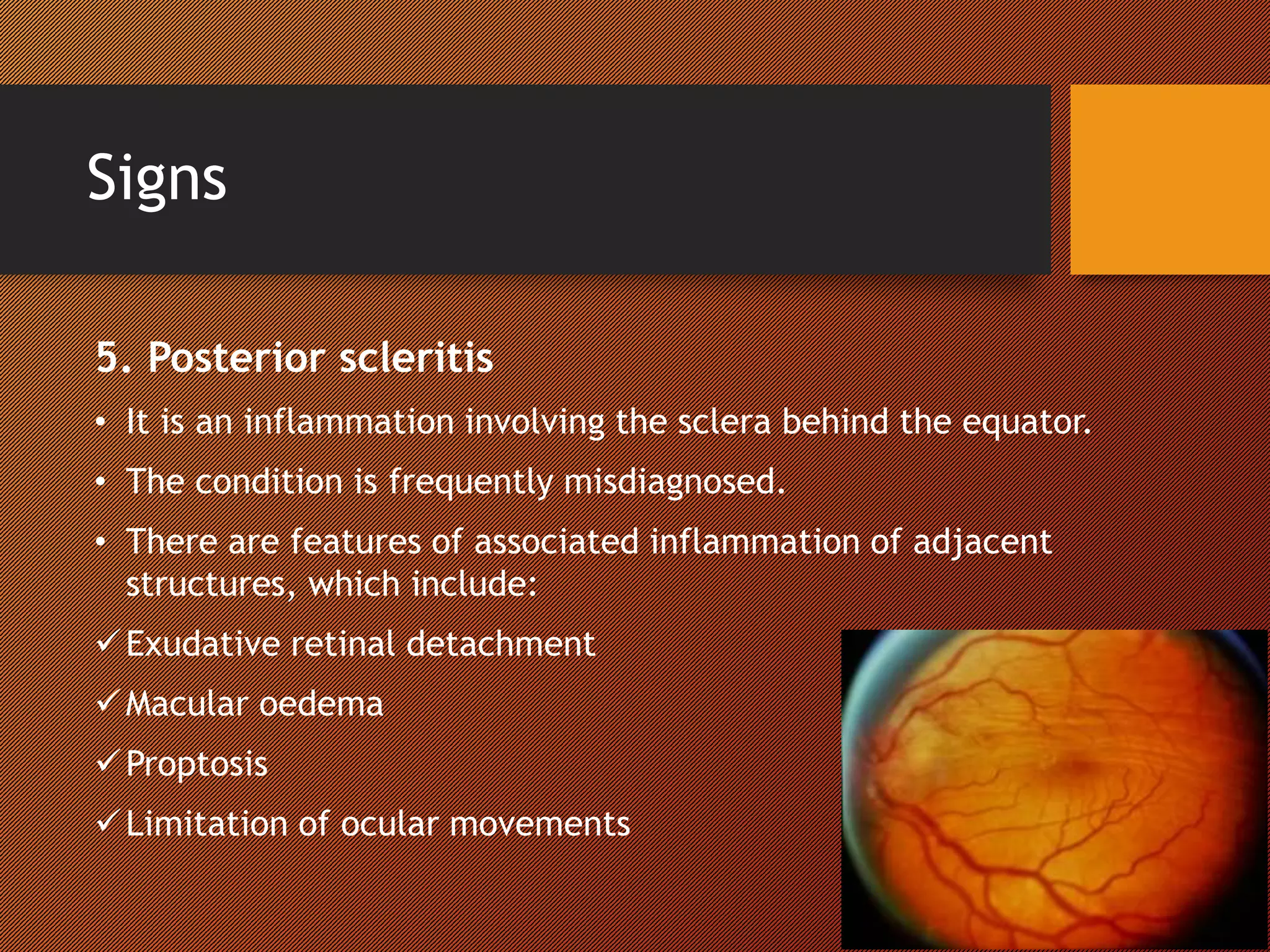 Signs
5. Posterior scleritis
• It is an inflammation involving the sclera behind the equator.
• The condition is frequently misdiagnosed.
• There are features of associated inflammation of adjacent
structures, which include:
Exudative retinal detachment
Macular oedema
Proptosis
Limitation of ocular movements
 