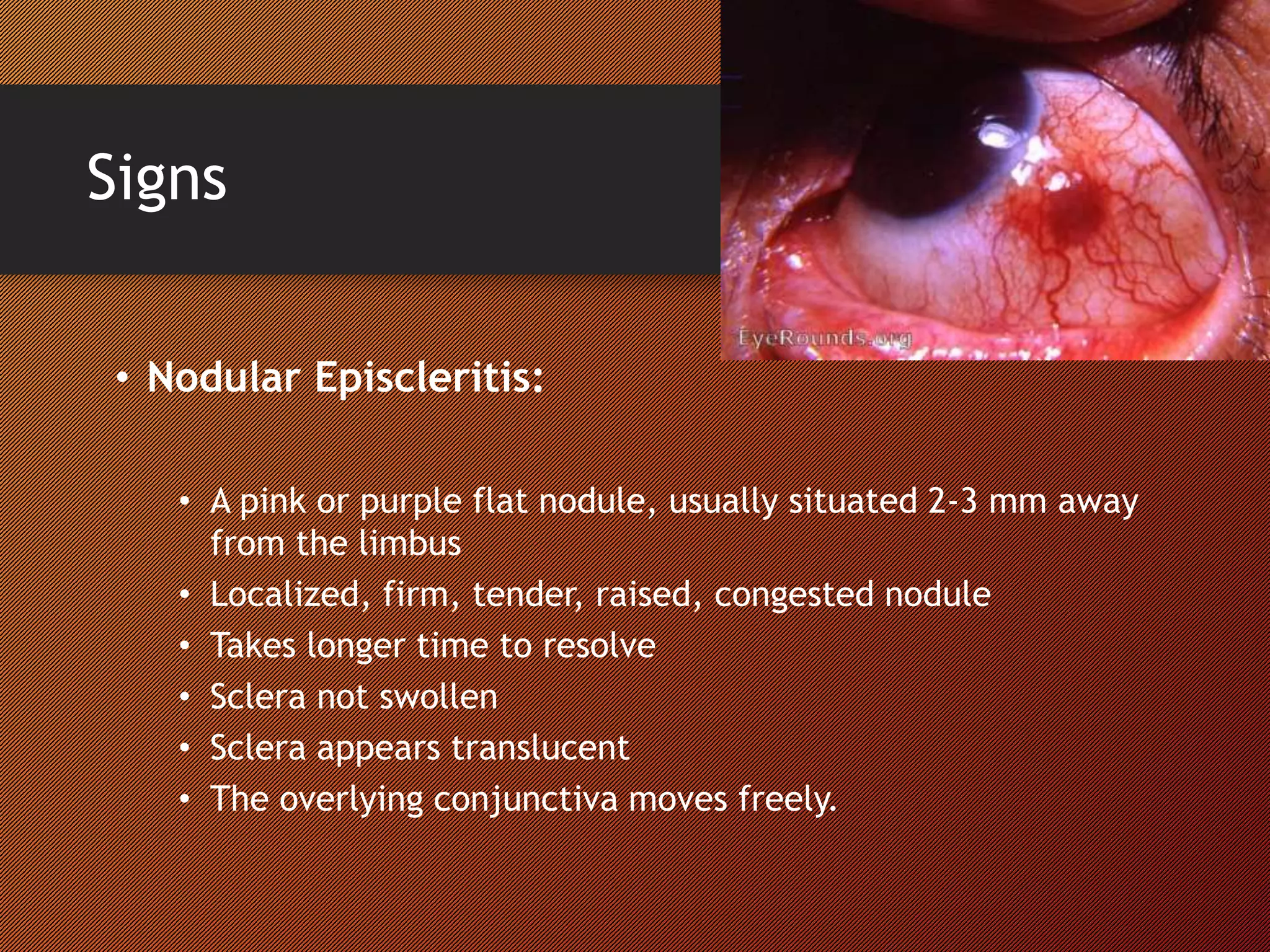 Signs
• Nodular Episcleritis:
• A pink or purple flat nodule, usually situated 2-3 mm away
from the limbus
• Localized, firm, tender, raised, congested nodule
• Takes longer time to resolve
• Sclera not swollen
• Sclera appears translucent
• The overlying conjunctiva moves freely.
 
