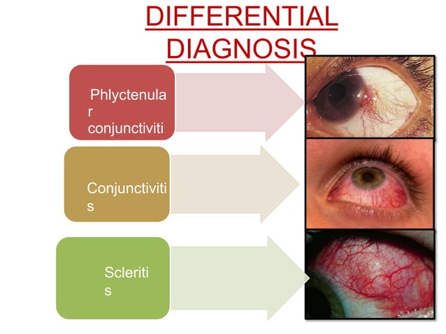 EPISCLERITIS AND SCLERITIS.pptx bbbbbbbb | PPTX | Eye and Vision ...