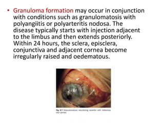 • Granuloma formation may occur in conjunction
with conditions such as granulomatosis with
polyangiitis or polyarteritis nodosa. The
disease typically starts with injection adjacent
to the limbus and then extends posteriorly.
Within 24 hours, the sclera, episclera,
conjunctiva and adjacent cornea become
irregularly raised and oedematous.
 