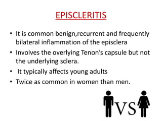 EPISCLERITIS
• It is common benign,recurrent and frequently
bilateral inflammation of the episclera
• Involves the overlying Tenon’s capsule but not
the underlying sclera.
• It typically affects young adults
• Twice as common in women than men.
 