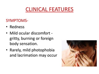 CLINICAL FEATURES
SYMPTOMS-
• Redness
• Mild ocular discomfort -
gritty, burning or foreign
body sensation.
• Rarely, mild photophobia
and lacrimation may occur
 