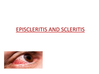 EPISCLERITIS AND SCLERITIS
 