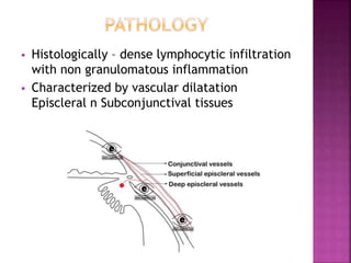  Histologically – dense lymphocytic infiltration
with non granulomatous inflammation
 Characterized by vascular dilatation
Episcleral n Subconjunctival tissues
 