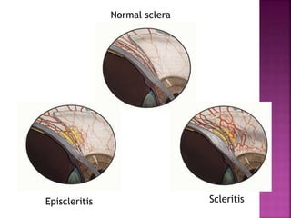 Normal sclera
Episcleritis Scleritis
 