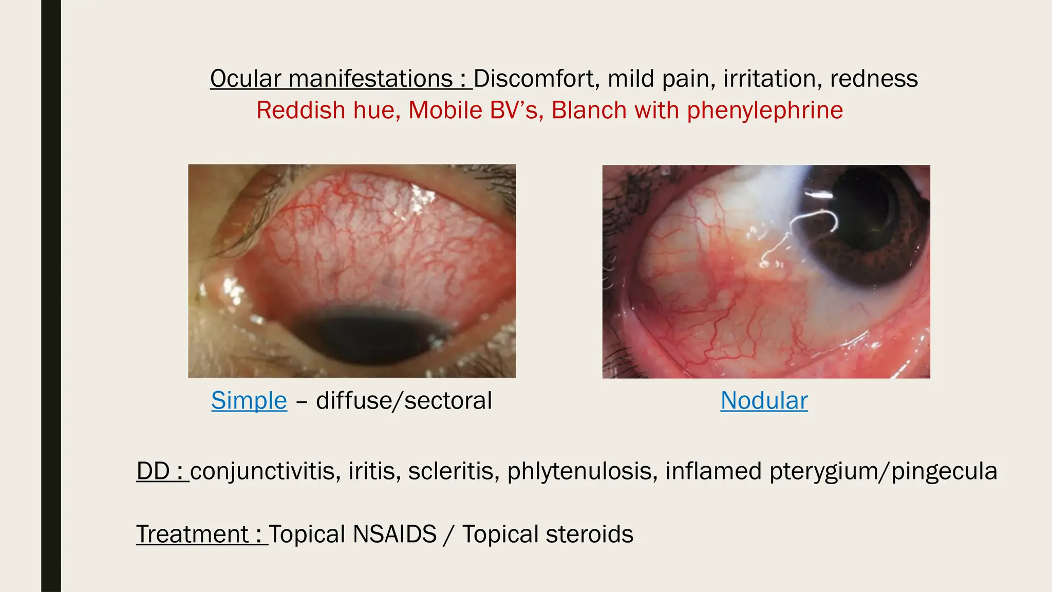 Episcleritis Scleritis causes Clinical Features Treatment pptx