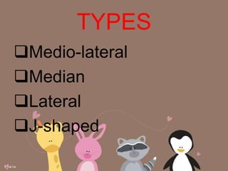 TYPES
Medio-lateral
Median
Lateral
J-shaped
 