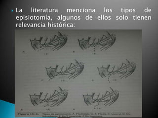  La literatura menciona los tipos de
episiotomía, algunos de ellos solo tienen
relevancia histórica:
 