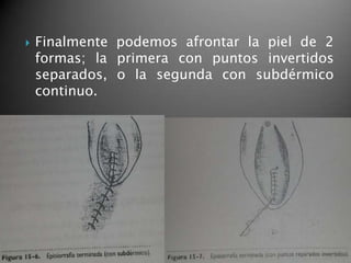  Finalmente podemos afrontar la piel de 2
formas; la primera con puntos invertidos
separados, o la segunda con subdérmico
continuo.
 