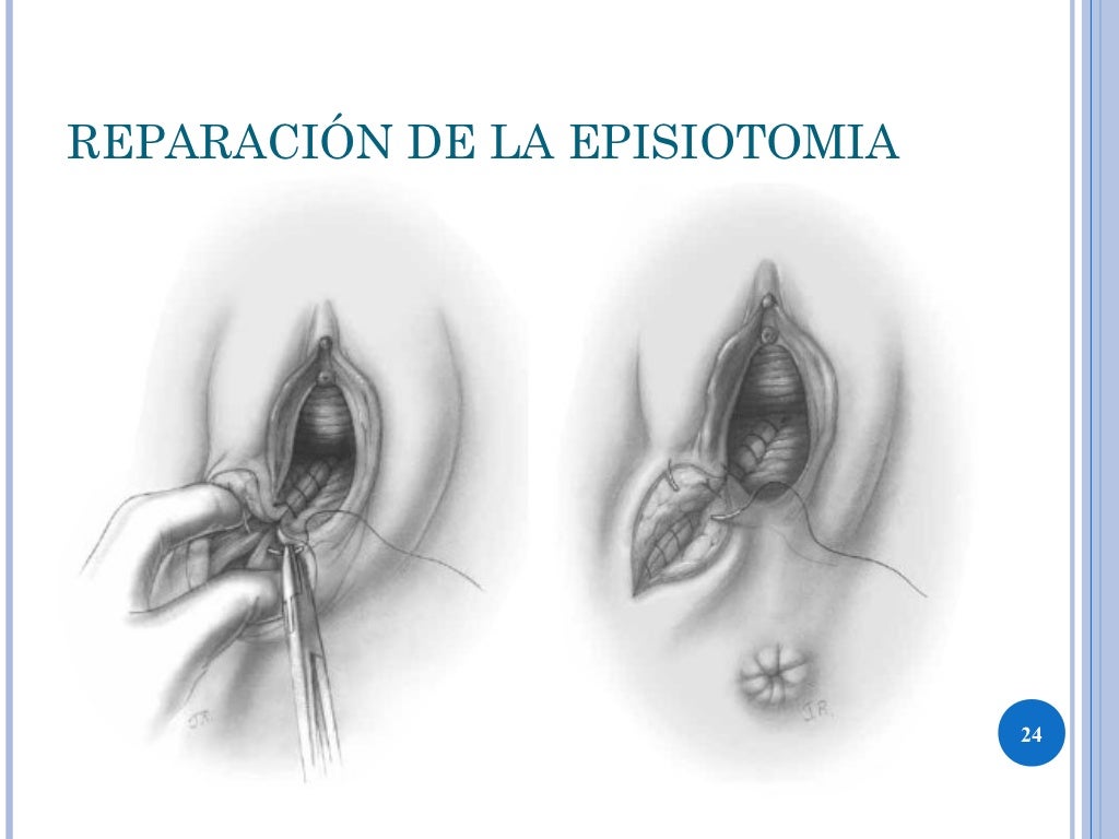 La Episiotomía