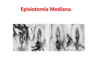Episiotomía Mediana.
 