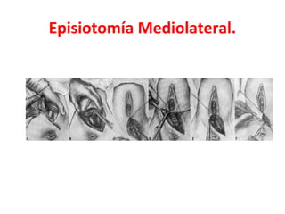 Episiotomía Mediolateral.
 