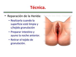 Técnica.
• Reparación de la Herida:
  – Realizarla cuando la
    superficie esté limpia y
    c/tejido granulación
  – Preparar intestino y
    ayuno la noche anterior.
  – Retirar el tejido de
    granulación.
 