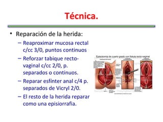 Técnica.
• Reparación de la herida:
  – Reaproximar mucosa rectal
    c/cc 3/0, puntos continuos
  – Reforzar tabique recto-
    vaginal c/cc 2/0, p.
    separados o continuos.
  – Reparar esfínter anal c/4 p.
    separados de Vicryl 2/0.
  – El resto de la herida reparar
    como una episiorrafia.
 