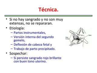 Técnica.
• Si no hay sangrado y no son muy
  extensas, no se repararan.
• Etiología:
  – Partos instrumentales,
  – Versión interna del segundo
    gemelo,
  – Deflexión de cabeza fetal y
  – Trabajo de parto precipitado.
• Sospechar:
  – Si persiste sangrado rojo brillante
    con buen tono uterino.
 