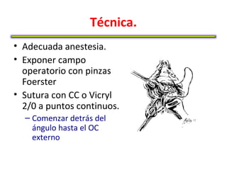 Técnica.
• Adecuada anestesia.
• Exponer campo
  operatorio con pinzas
  Foerster
• Sutura con CC o Vicryl
  2/0 a puntos continuos.
  – Comenzar detrás del
    ángulo hasta el OC
    externo
 
