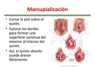 Marsupialización
• Cortar la piel sobre el
  quiste.
• Suturar los bordes
  para formar una
  superficie continua del
  exterior al interior del
  quiste.
• Así, el quiste abierto
  puede drenar
  libremente.
 