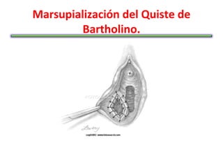 Marsupialización del Quiste de
         Bartholino.
 