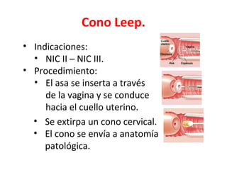 Cono Leep.
• Indicaciones:
  • NIC II – NIC III.
• Procedimiento:
  • El asa se inserta a través
     de la vagina y se conduce
     hacia el cuello uterino.
  • Se extirpa un cono cervical.
  • El cono se envía a anatomía
     patológica.
 