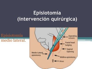Episiotomía
(intervención quirúrgica)
Episiotomía
medio lateral.
 