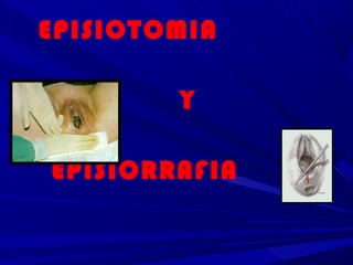 EPISIOTOMIA

        Y

EPISIORRAFIA
 