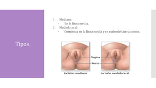 Tipos
1. Mediana:
 En la línea media.
2. Mediolateral:
 Comienza en la línea media y se extiende lateralmente.
 