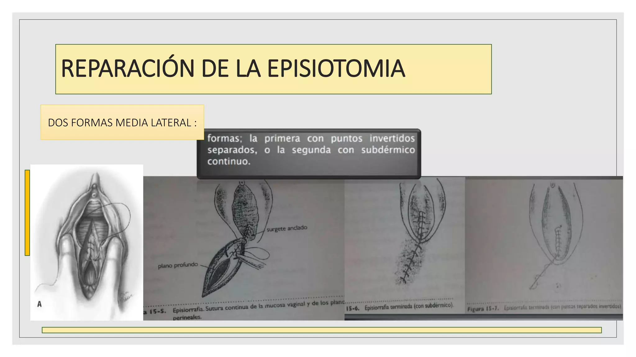 EPISIOTOMIA BERENNI CORTES RDY.pptx