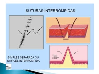Episiotomia, episiorrafia e suturas