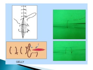 Episiotomia, episiorrafia e suturas