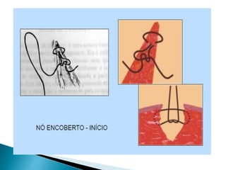 Episiotomia, episiorrafia e suturas