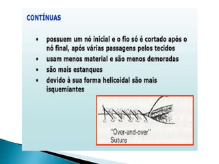 Episiotomia, episiorrafia e suturas