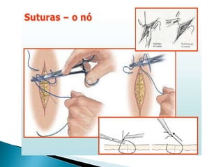 Episiotomia, episiorrafia e suturas
