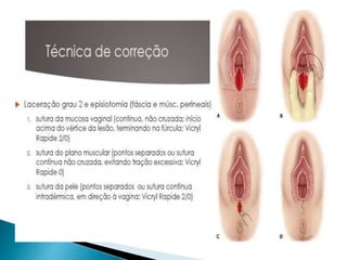 Episiotomia, episiorrafia e suturas