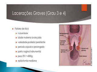 Episiotomia, episiorrafia e suturas