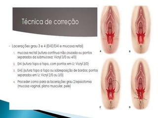 Episiotomia, episiorrafia e suturas