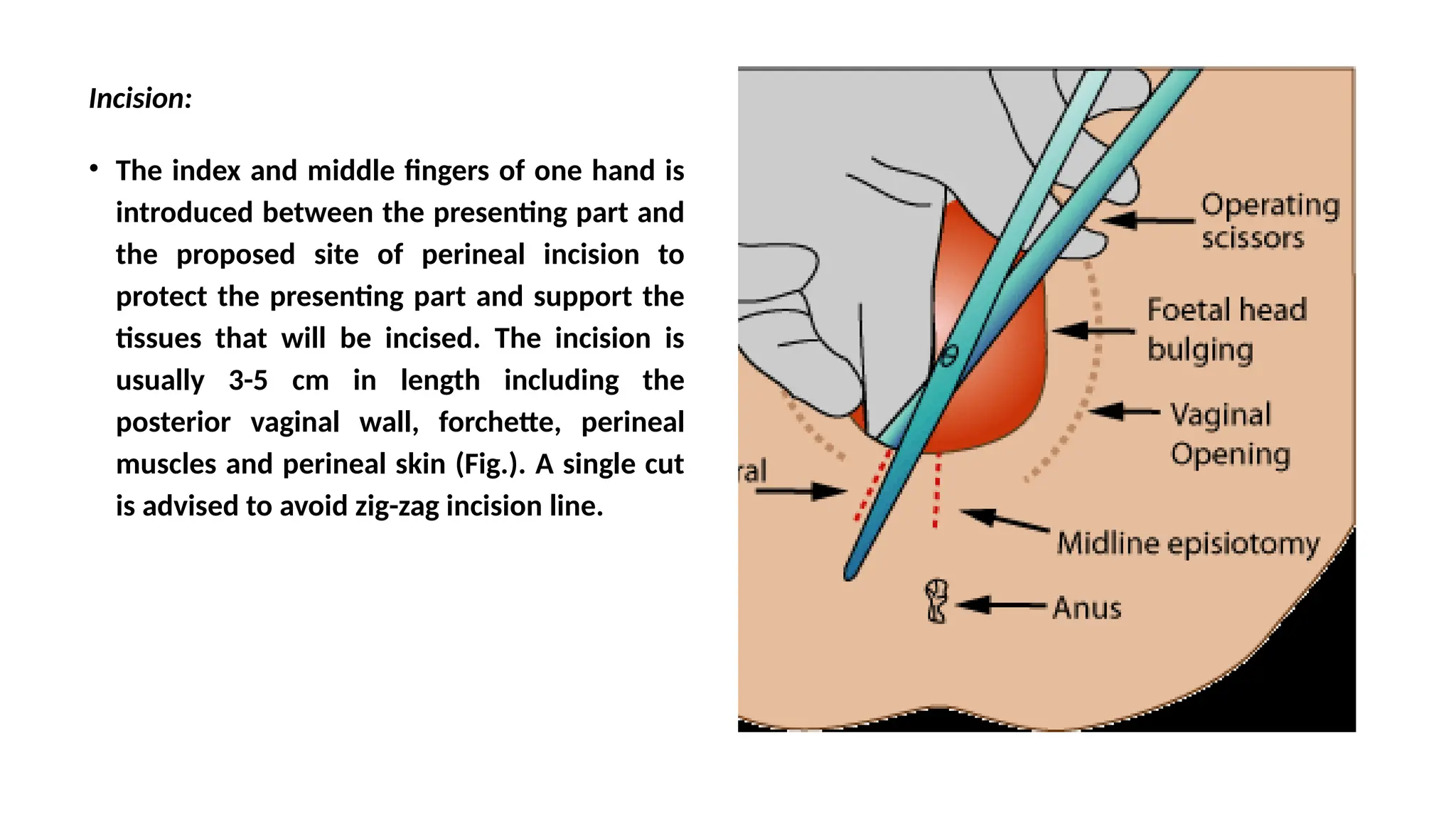 Management of Episiotomies and perineal tears .pptx