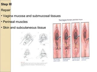Step III
Repair
• Vagina mucosa and submucosal tissues
• Perineal muscles
• Skin and subcutaneous tissue
 