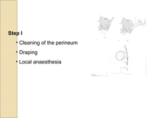 Step I
• Cleaning of the perineum
• Draping
• Local anaesthesia
 