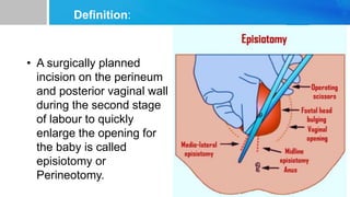 Definition:
• A surgically planned
incision on the perineum
and posterior vaginal wall
during the second stage
of labour to quickly
enlarge the opening for
the baby is called
episiotomy or
Perineotomy.
 