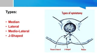 Types:
• Median
• Lateral
• Medio-Lateral
• J-Shaped
 